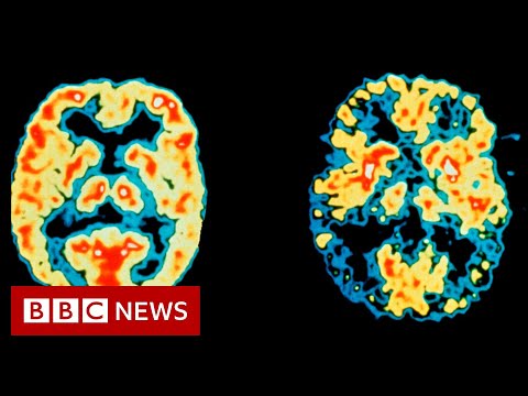 US approves first new Alzheimer’s drug in 20 years – BBC News